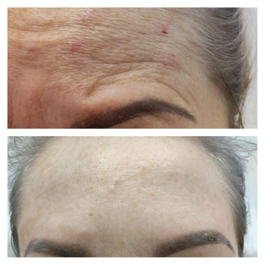 Efekt działania zabiegu redukcji zmarszczek BTX Effect Wrocław Rosińska Beauty & Estetik