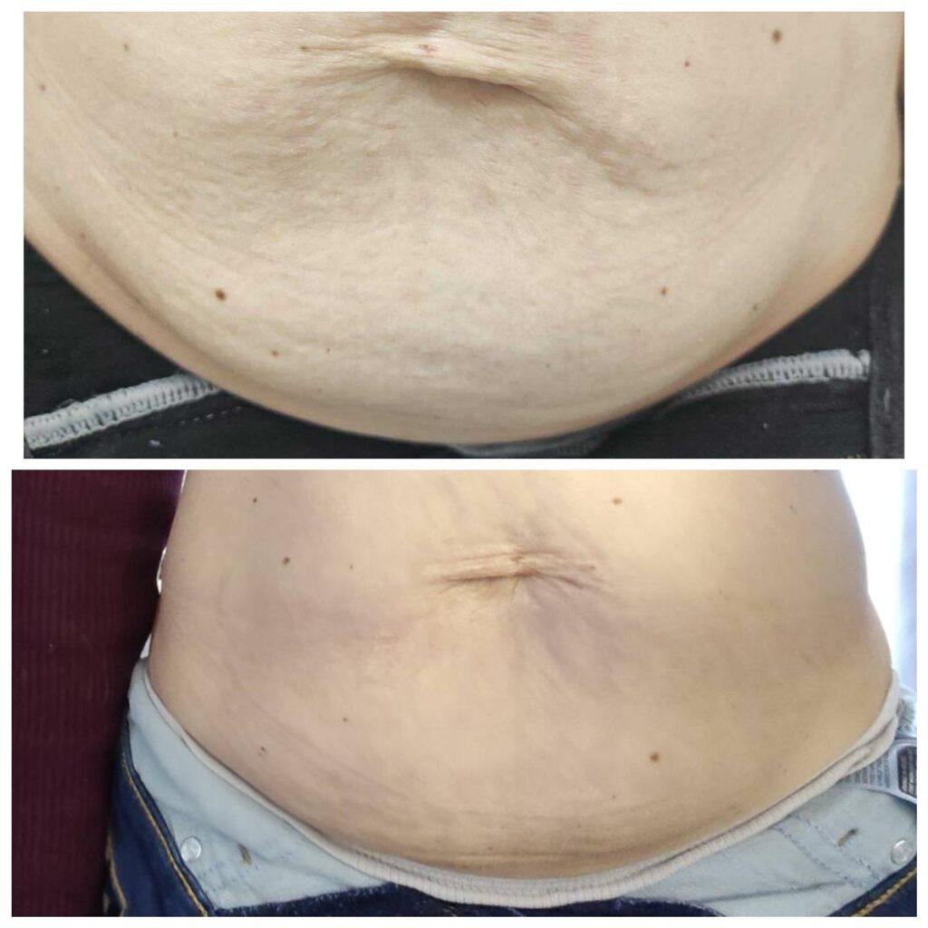 radiofrekwencja-mikroiglowa