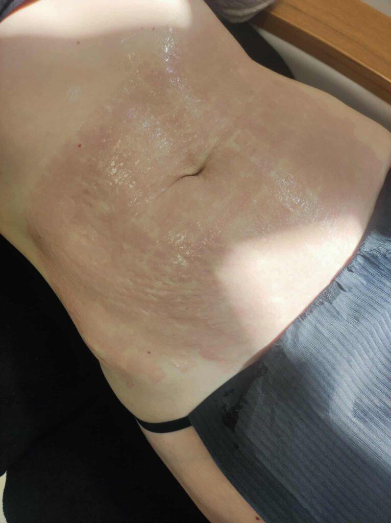 radiofrekwencja-mikroiglowa