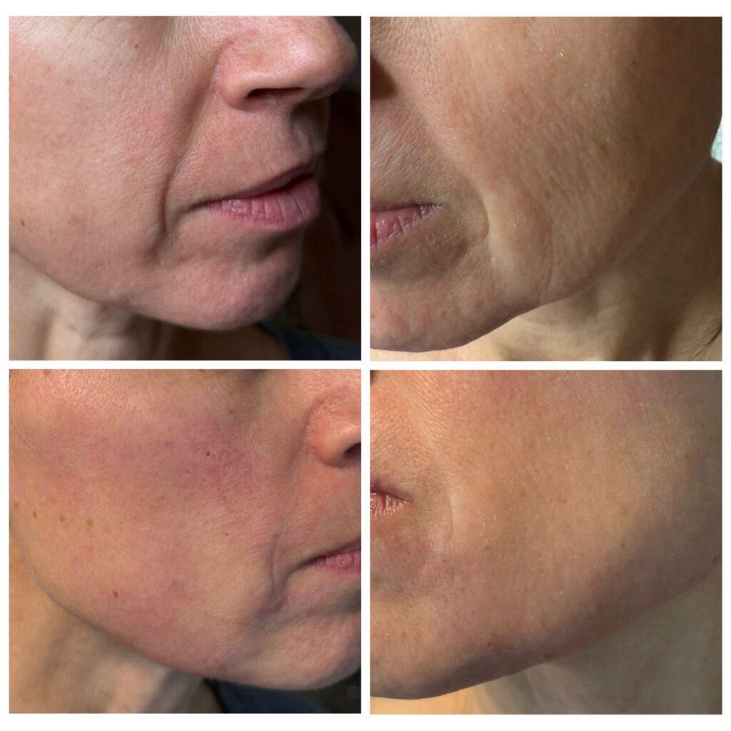 Algeness algeness-zabieg-lifting