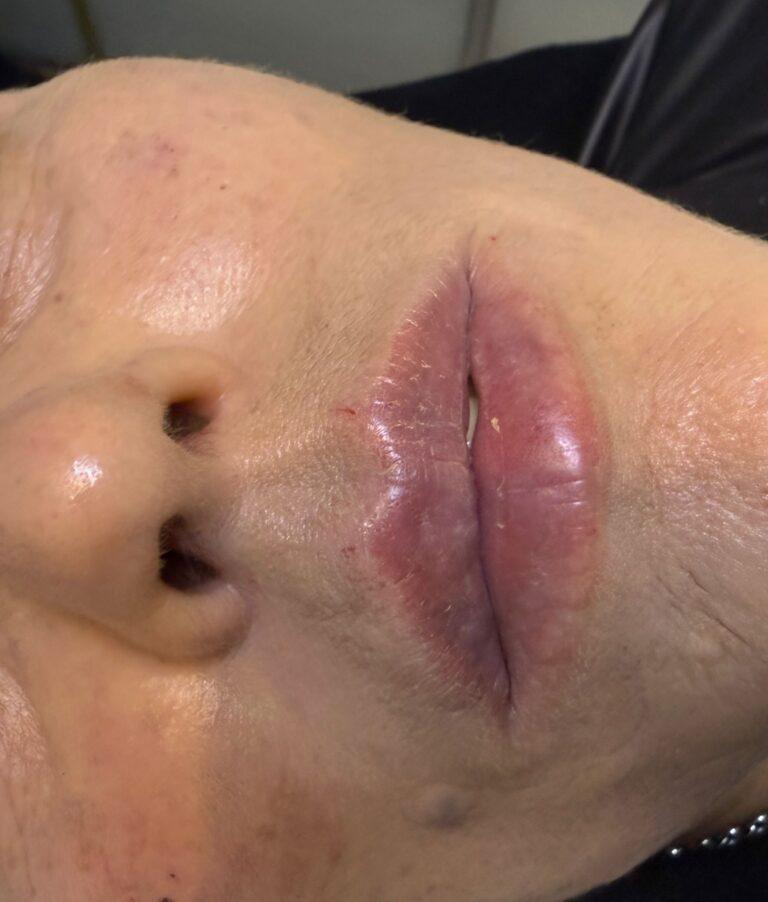 powiekszanie=ust-wroclaw